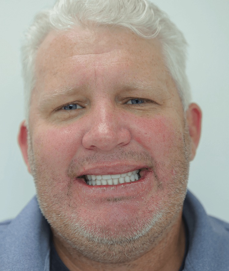All on 4 Dental Treatment - Freer Dental Implant Center